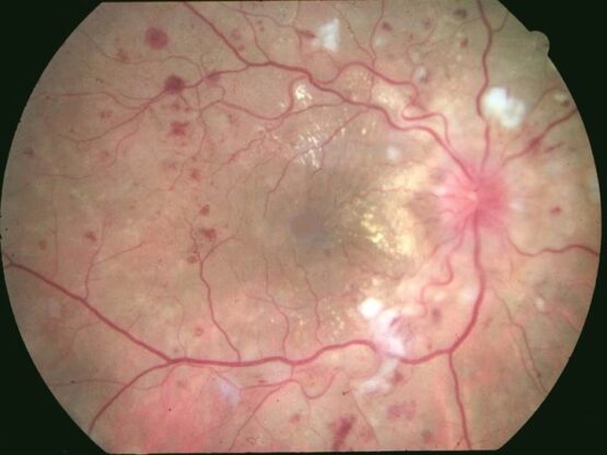 Rétinopathie hypertensive : diagnostic par fond d'oeil - Clinique ...